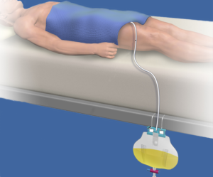 Continuous Bladder Drainage (CBD) Insertion