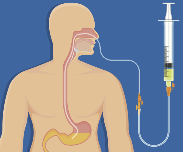 Nasogastric Tube Insertion